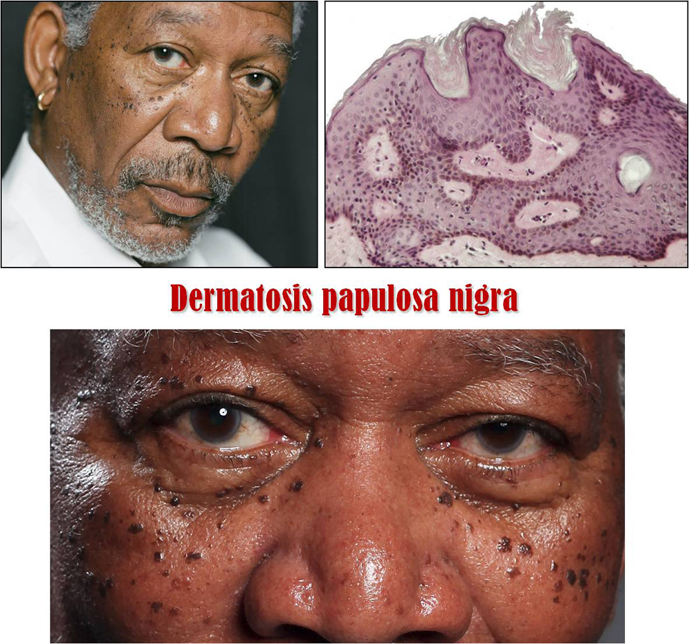 dermatosis papulosa nigra
