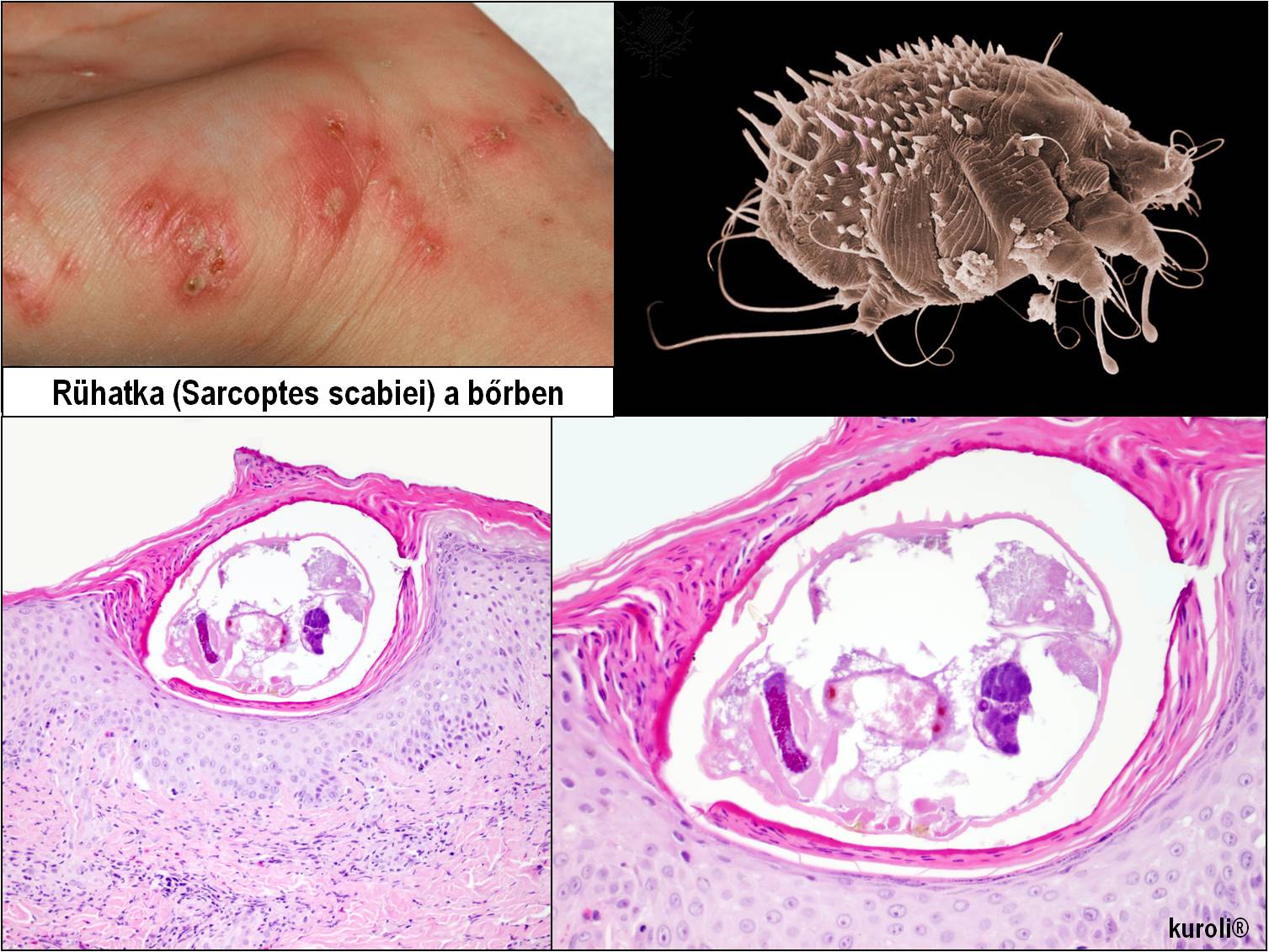 paraziták a bőrön rüh kenet a Candida férfiakban